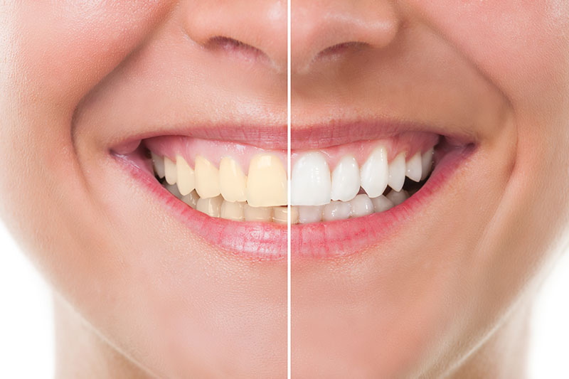 Teeth Whitening in Tarzana